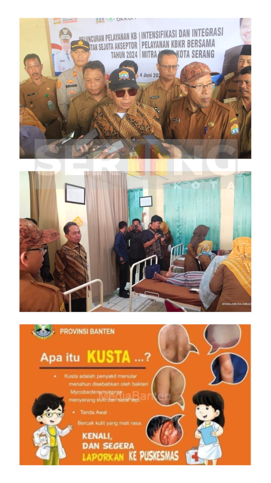 Penyakit Kusta bayangi HARGANAS di Kota Serang, Pj Walikota peroleh laporan 1 keluarga terkena Kusta